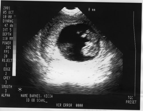 10 week ultrasound picture