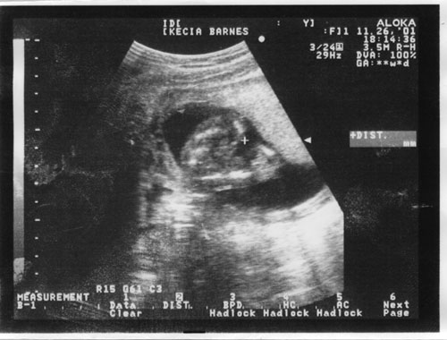 17 week ultrasound picture 2 