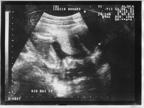 17 week ultrasound picture 3 