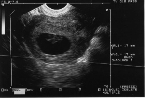 8 week ultrasound picture